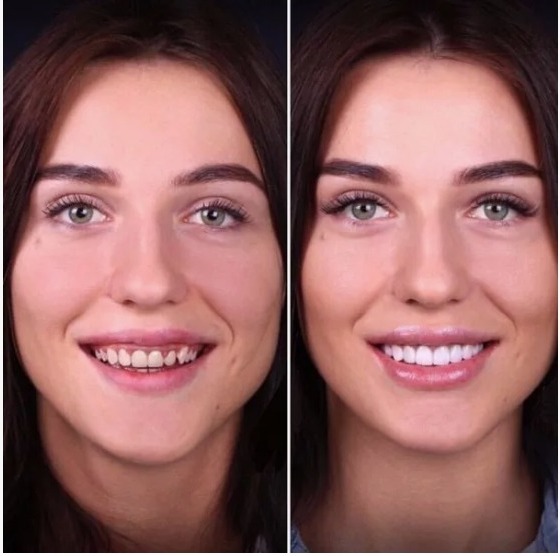 виниры на зубы установка